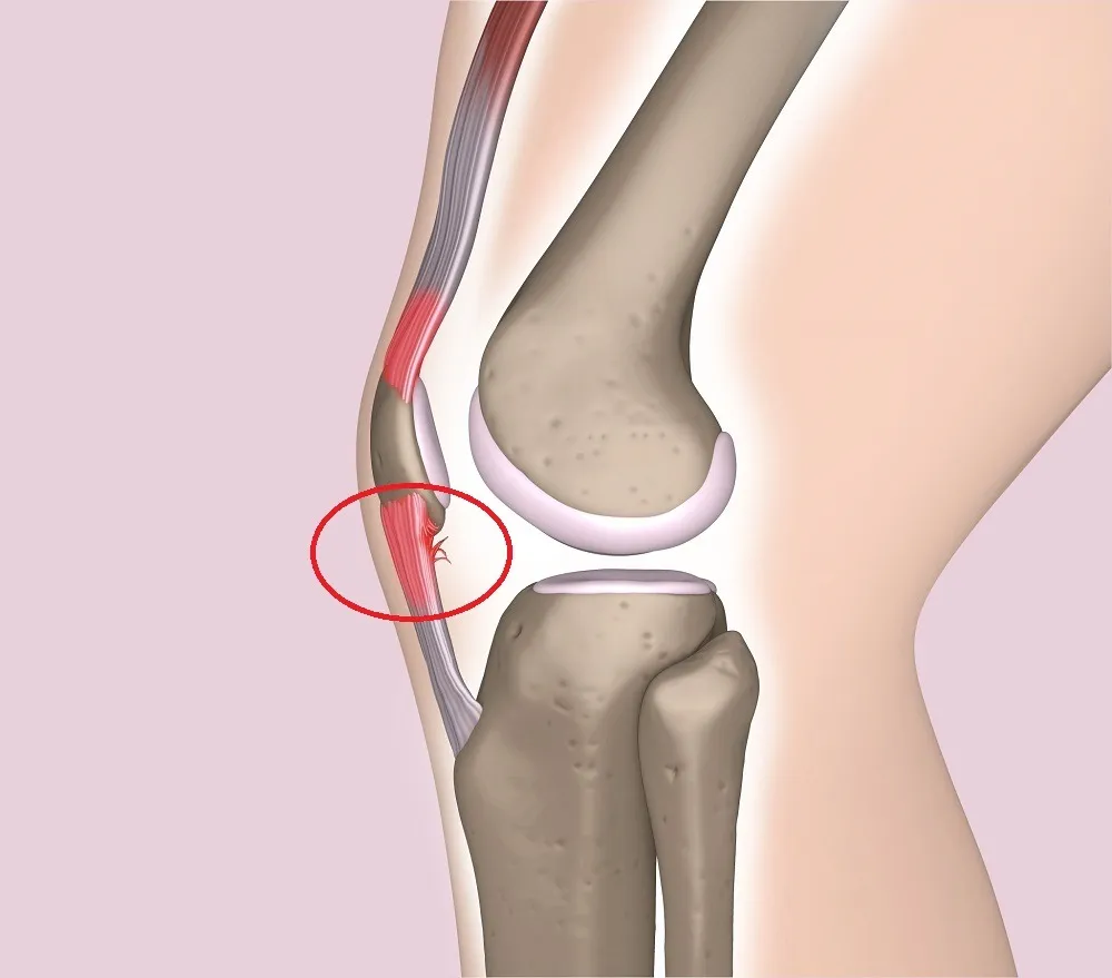 【成長痛　ジャンパー膝　整骨院】ジャンパー膝（膝蓋腱炎）について