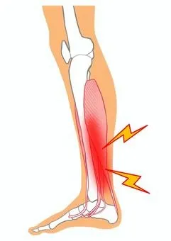 【成長痛 シンスプリント 整骨院】シンスプリント(脛骨過労性骨膜炎)について